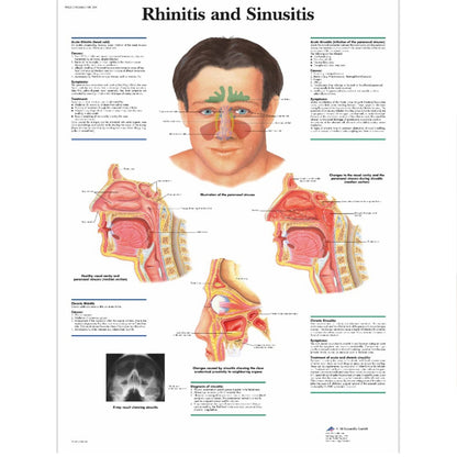 Nose Rhinitis Sinusitis Cure Therapy Nose Massage