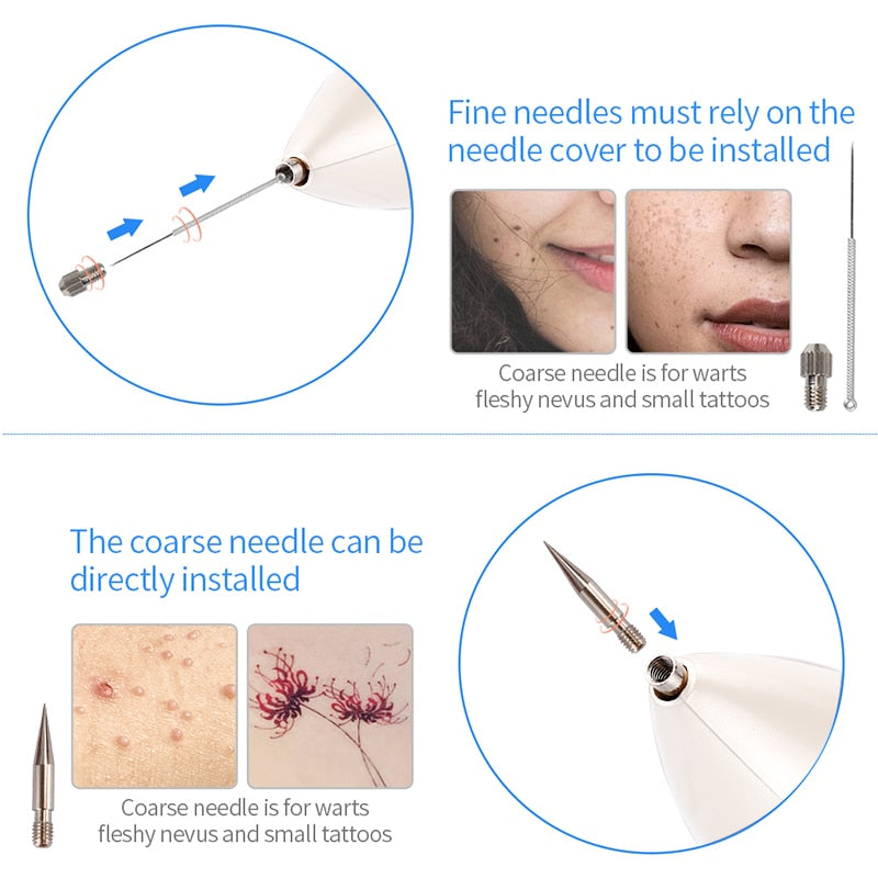 Plasma Pen To Remove Freckles